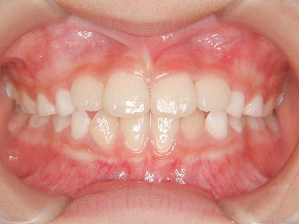 小児矯正 受け口(一期治療) 治療後の写真